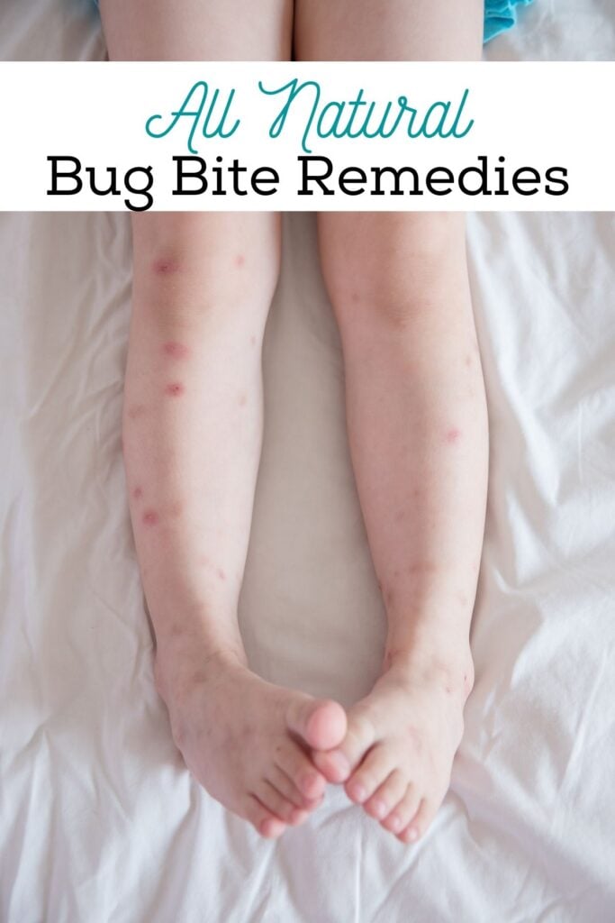 child's legs with insect bites on them and text overlay 'All Natural Bug Bite Remedies'